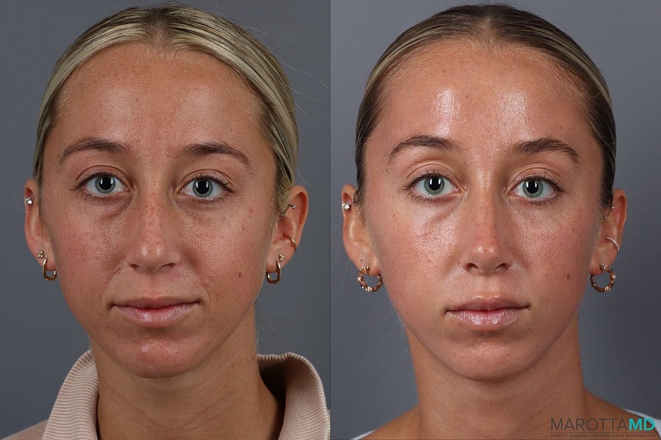 Nose Surgery Before & After