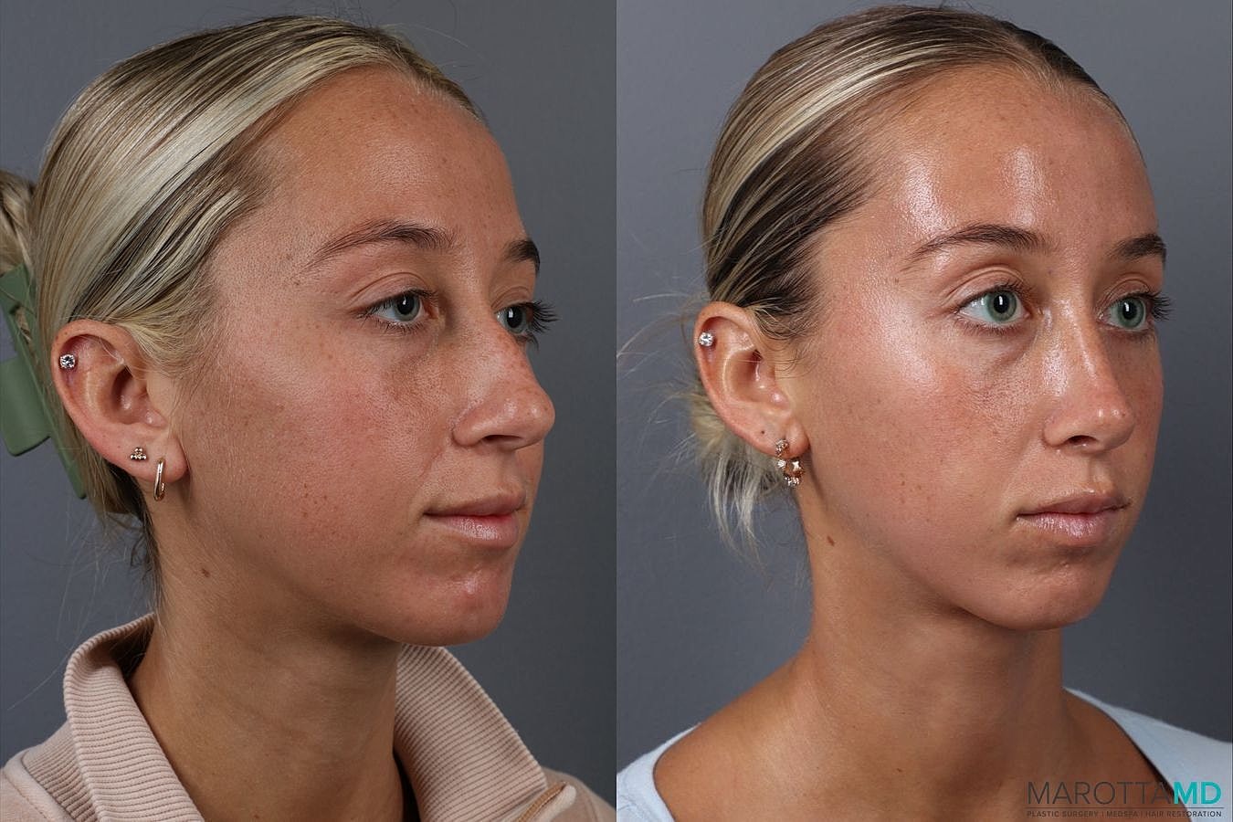 Nose Surgery Before & After