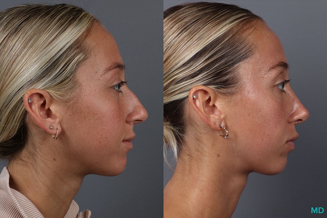 Nose Surgery Before & After