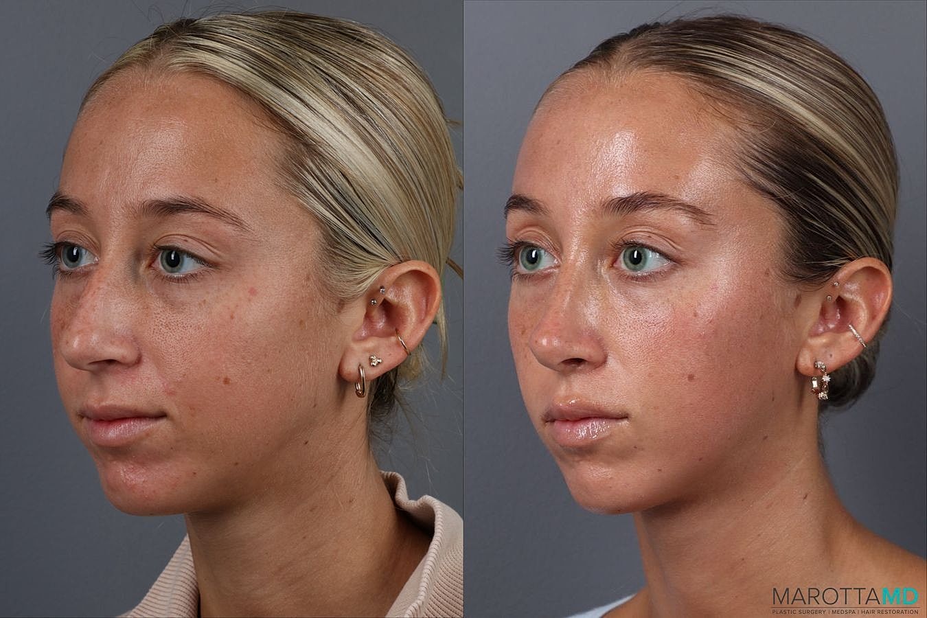 Nose Surgery Before & After