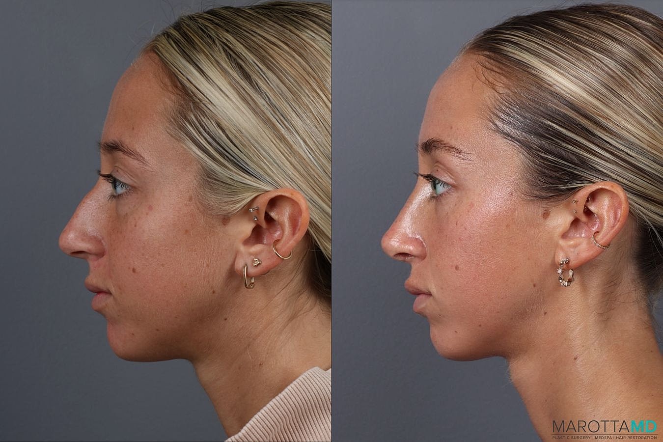 Nose Surgery Before & After