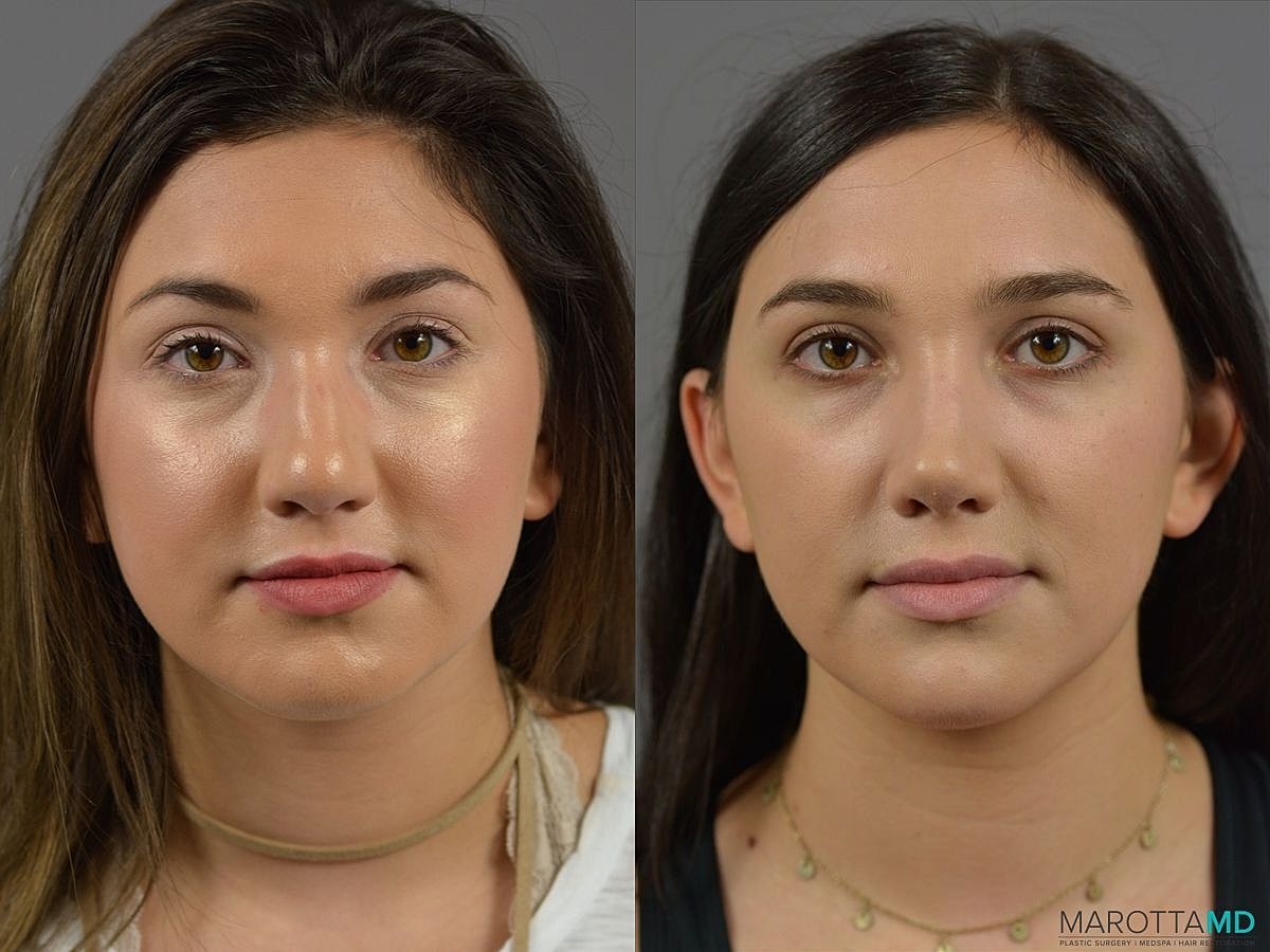 Nose Surgery Before & After