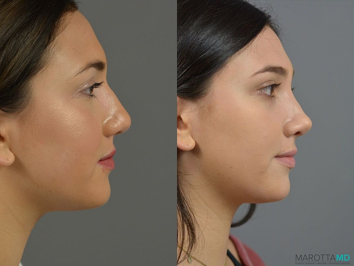 Nose Surgery Before & After