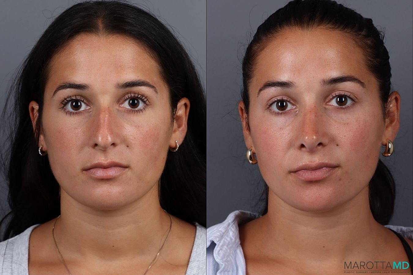 Nose Surgery Before & After