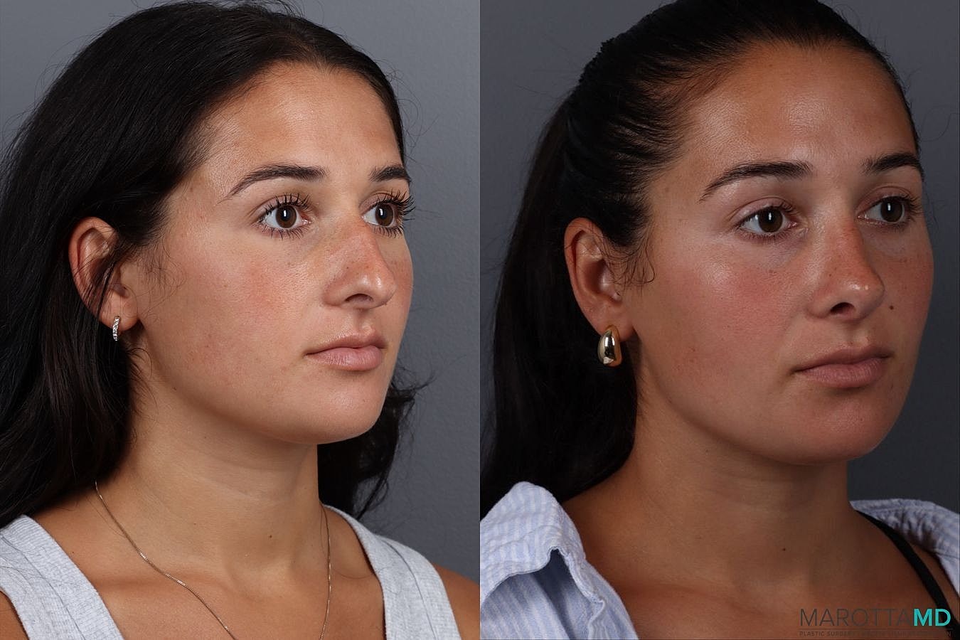 Nose Surgery Before & After