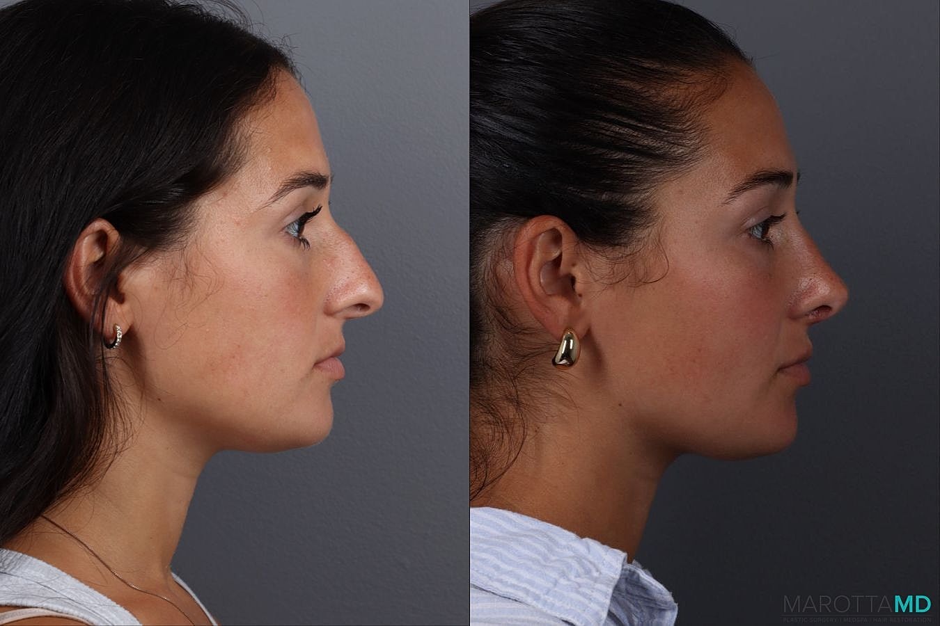 Nose Surgery Before & After