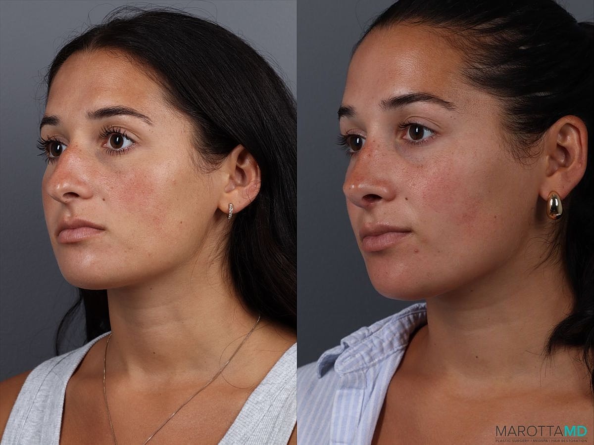Nose Surgery Before & After