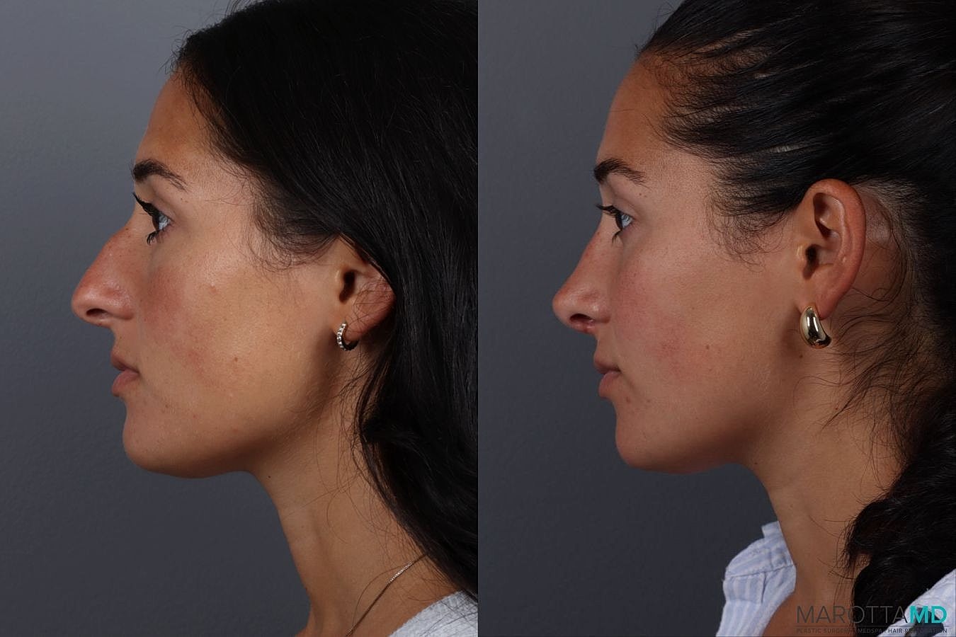 Nose Surgery Before & After