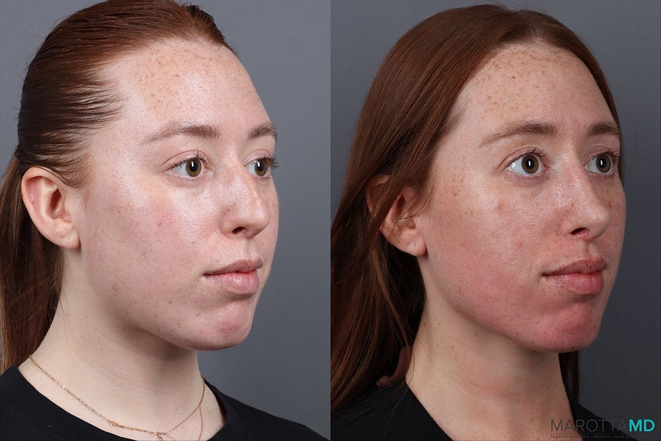 Nose Surgery Before & After