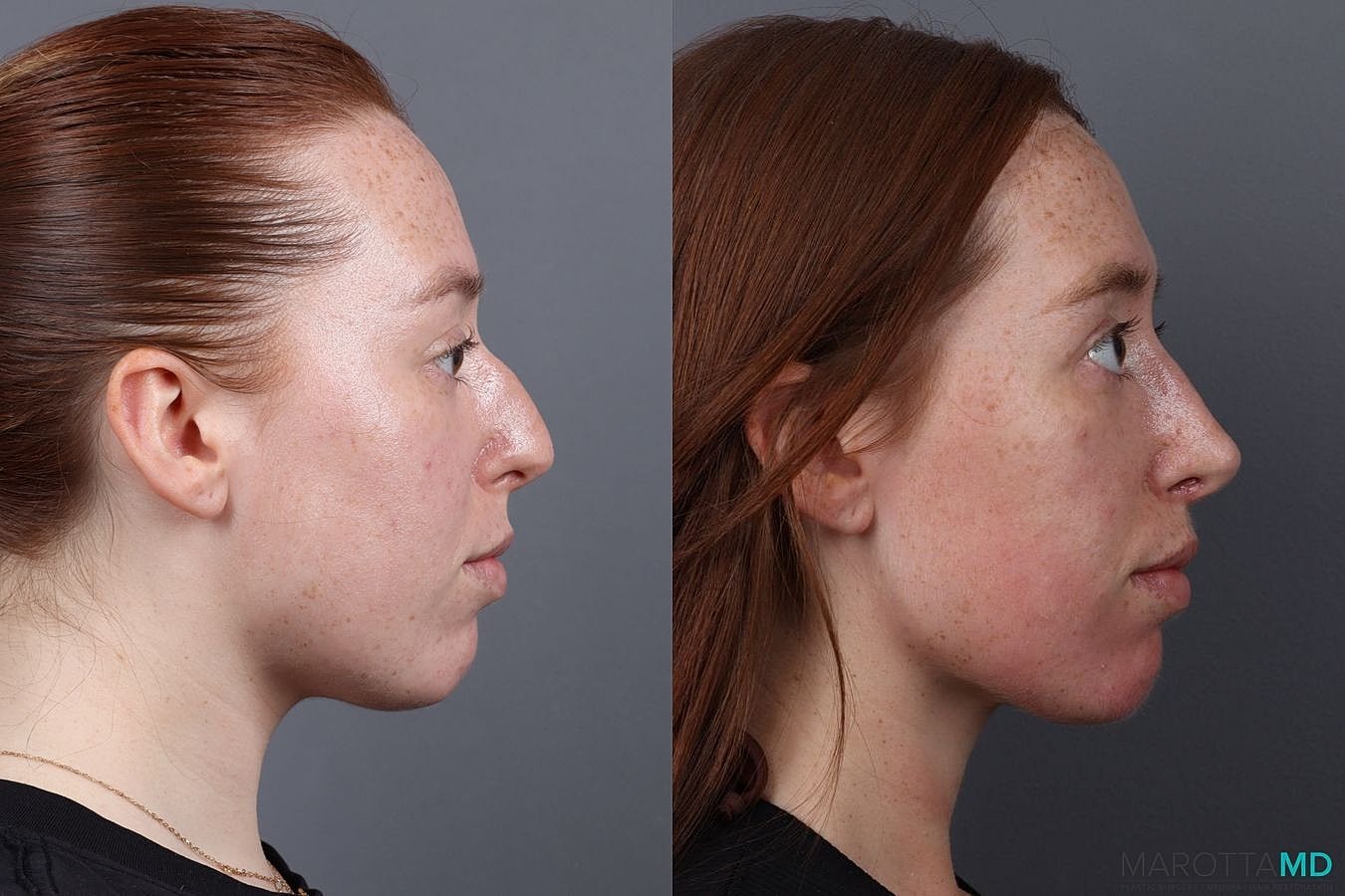 Nose Surgery Before & After