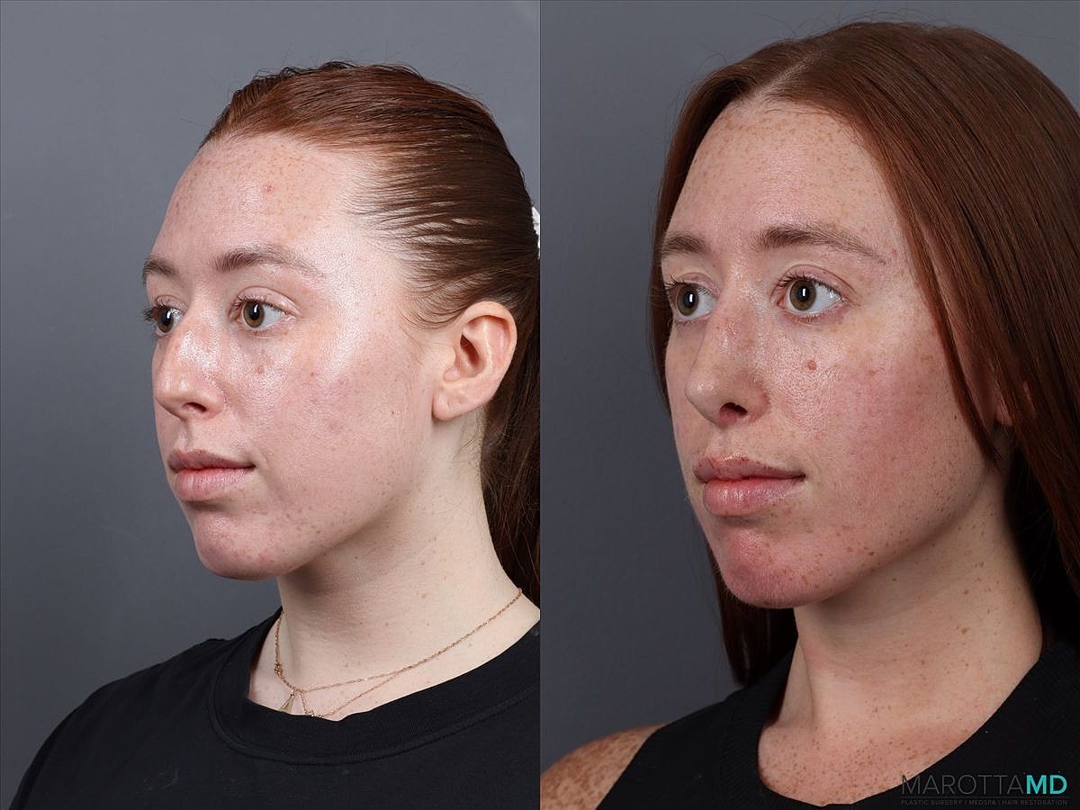 Nose Surgery Before & After