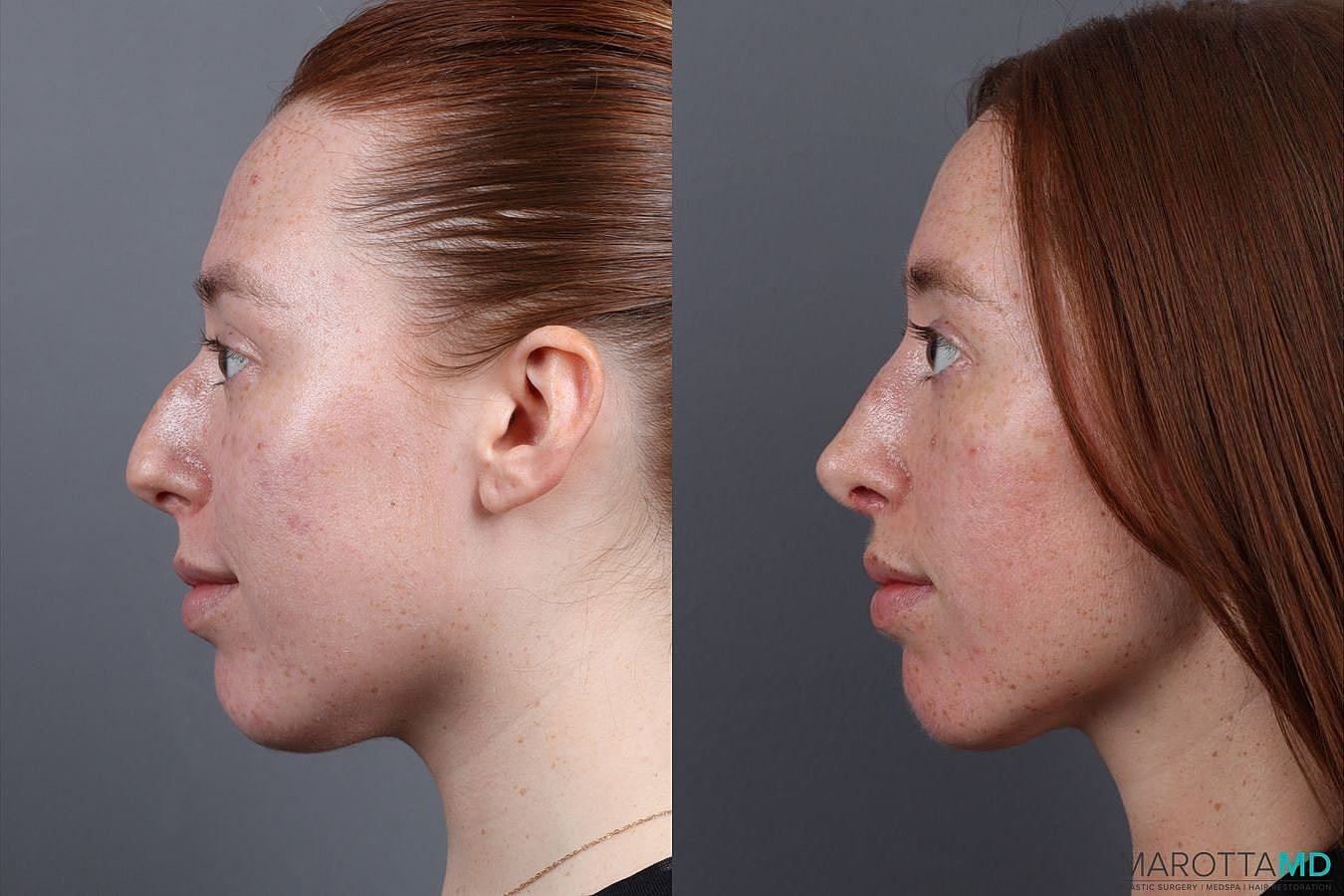 Nose Surgery Before & After