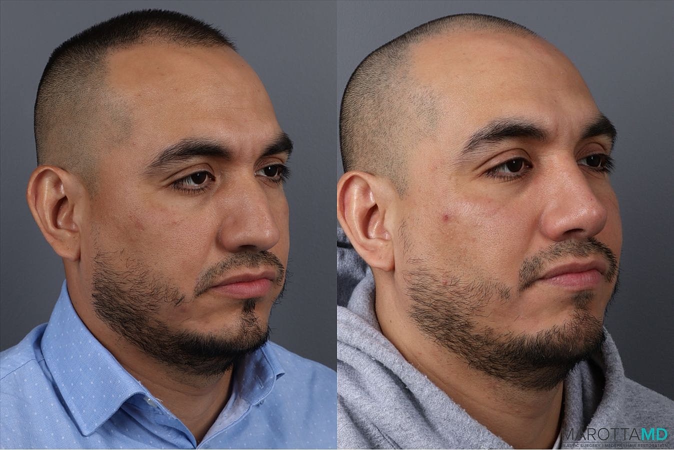 Nose Surgery Before & After