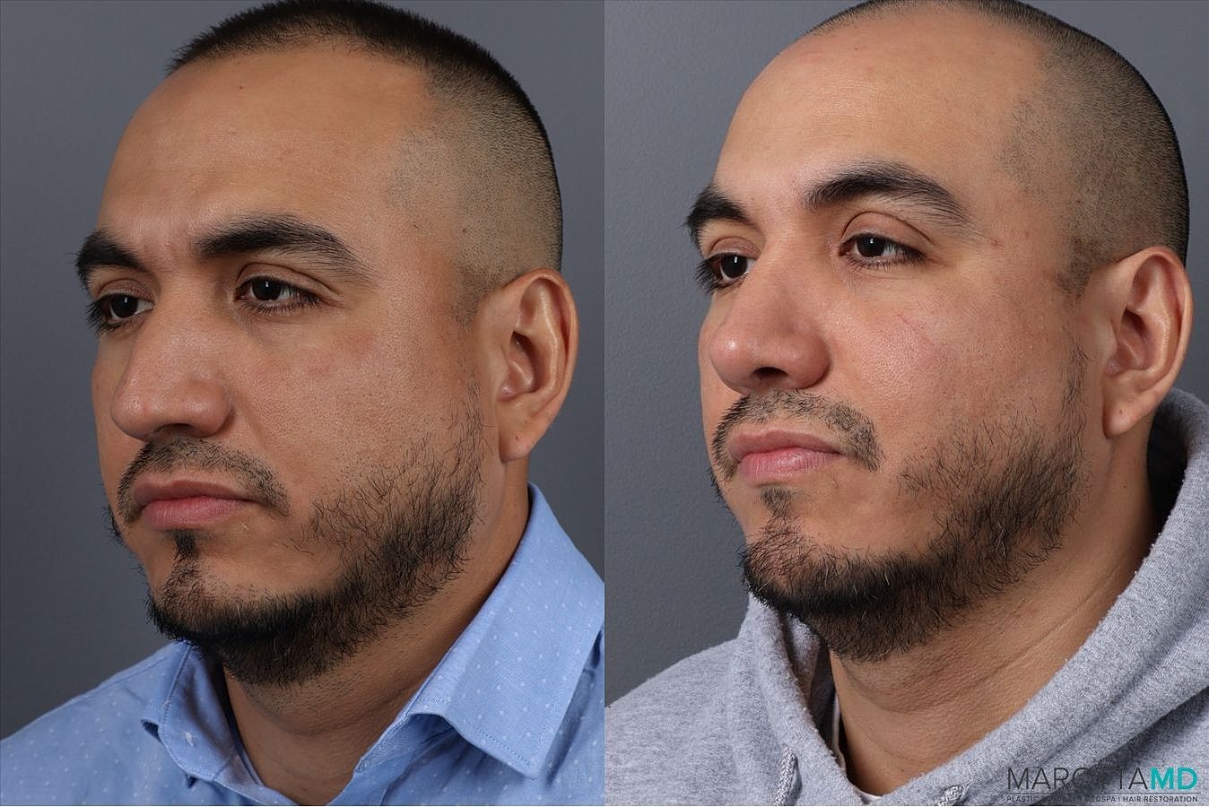 Nose Surgery Before & After