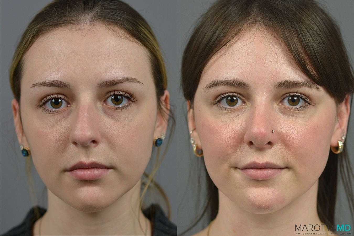 Nose Surgery Before & After