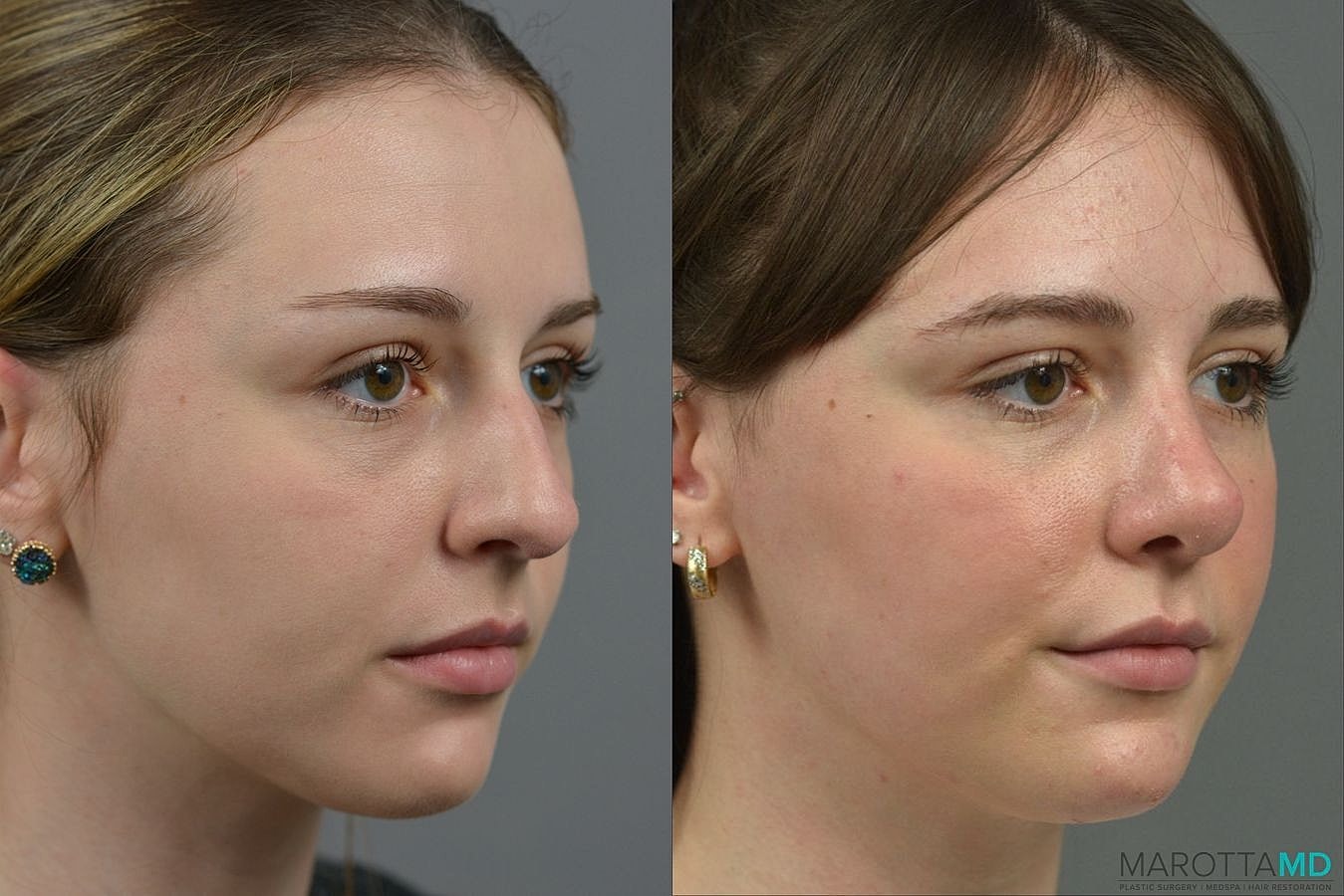 Nose Surgery Before & After