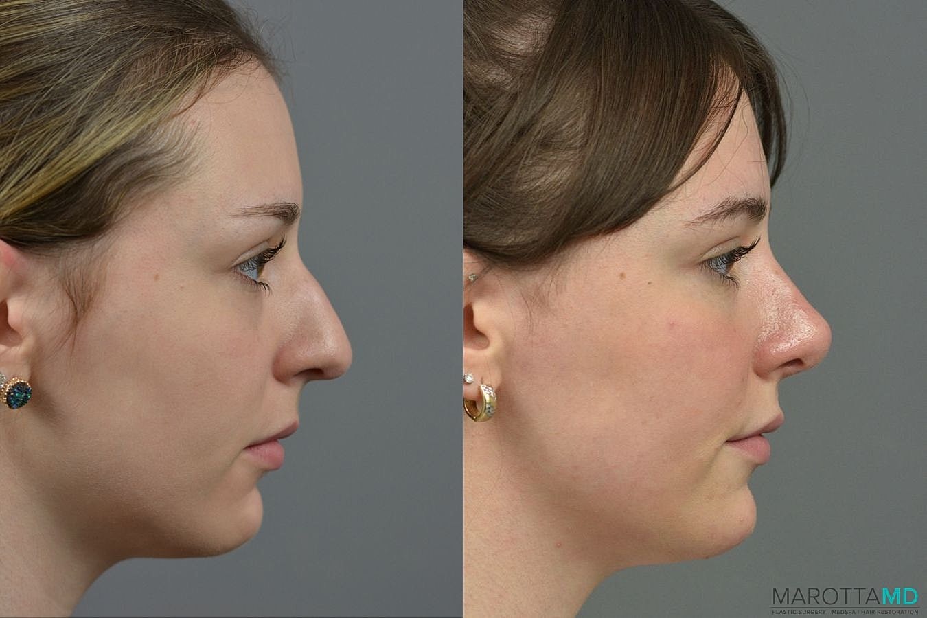 Nose Surgery Before & After