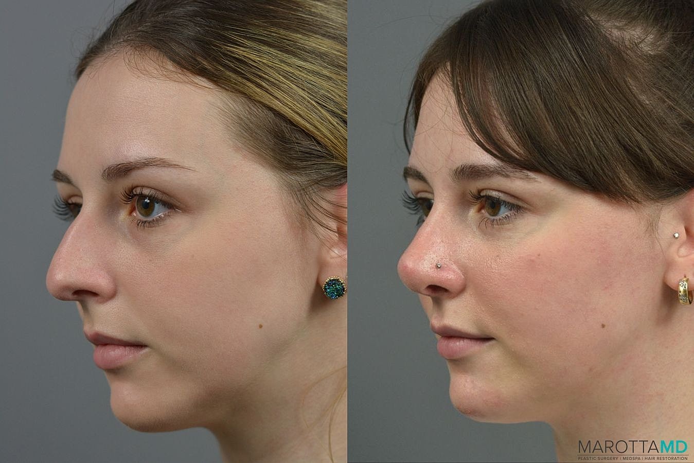 Nose Surgery Before & After
