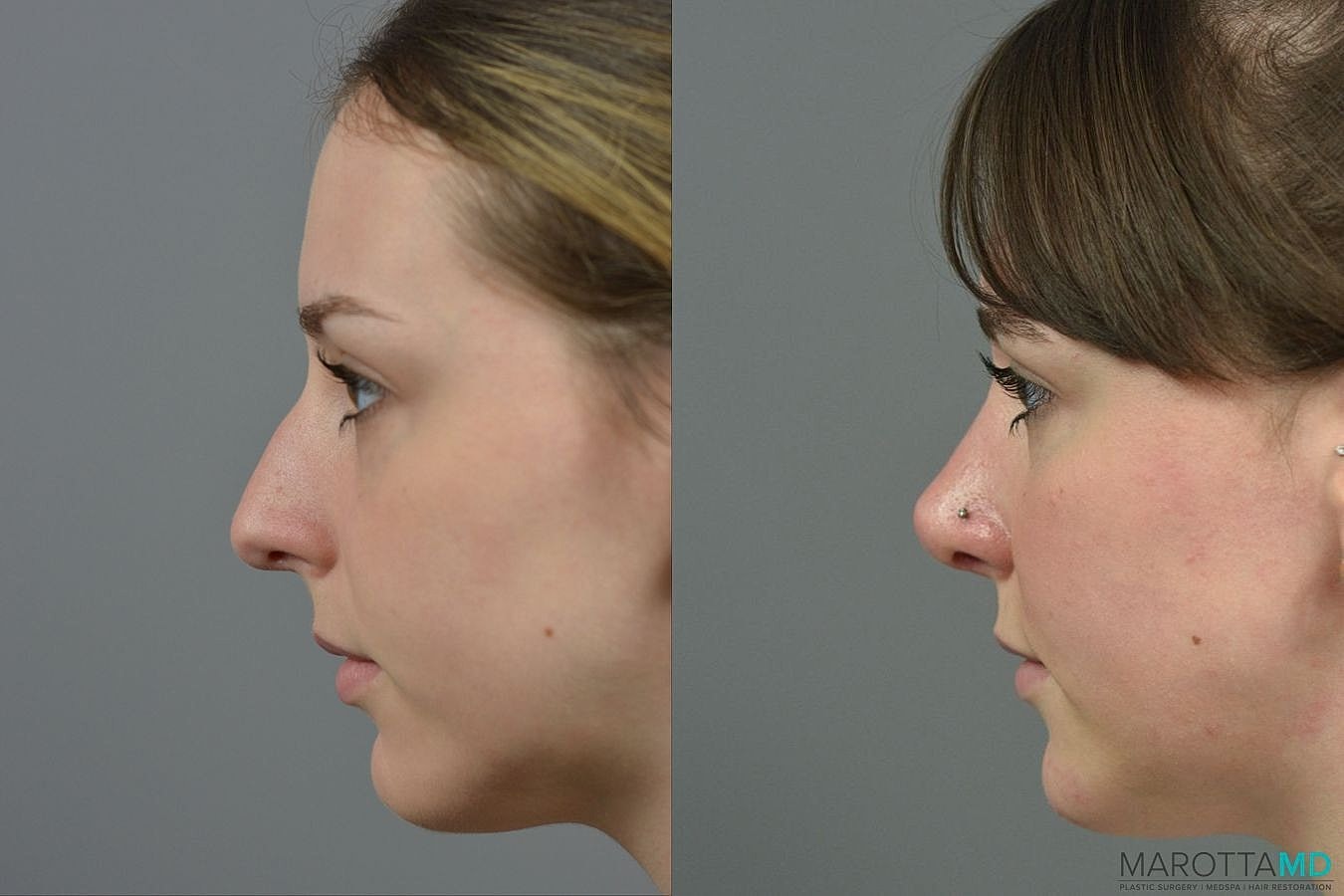 Nose Surgery Before & After