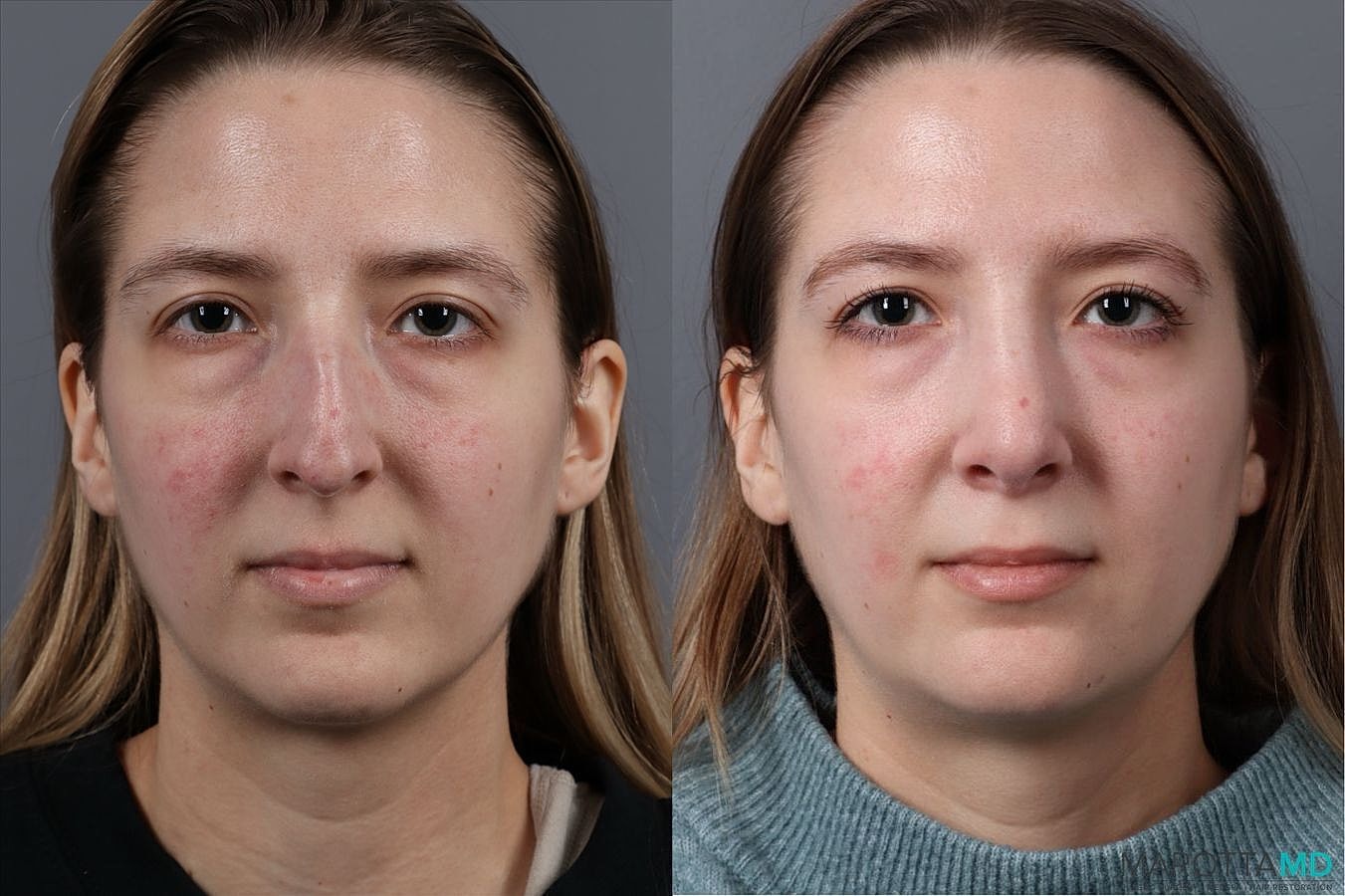 Nose Surgery Before & After