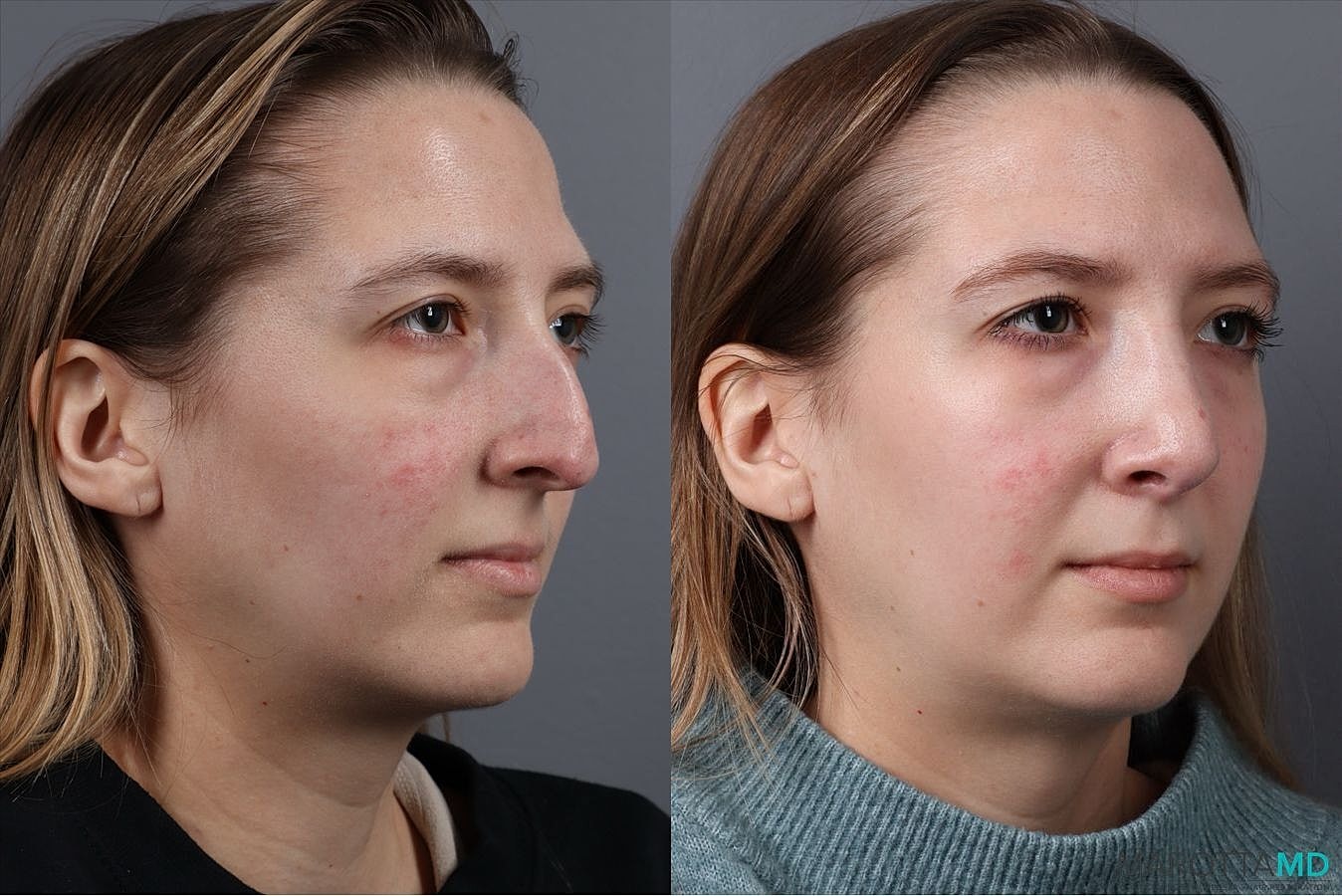 Nose Surgery Before & After