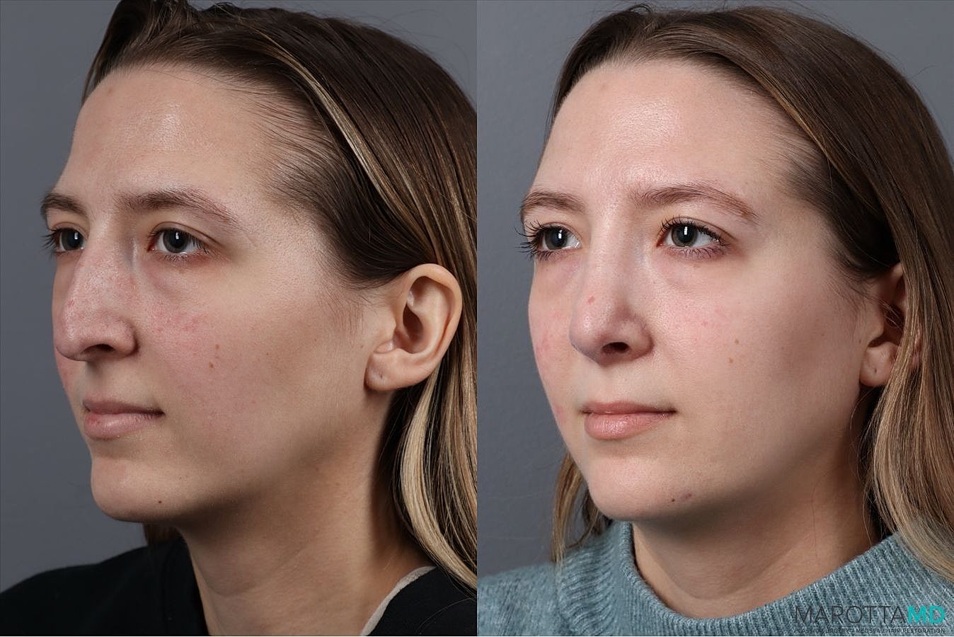 Nose Surgery Before & After