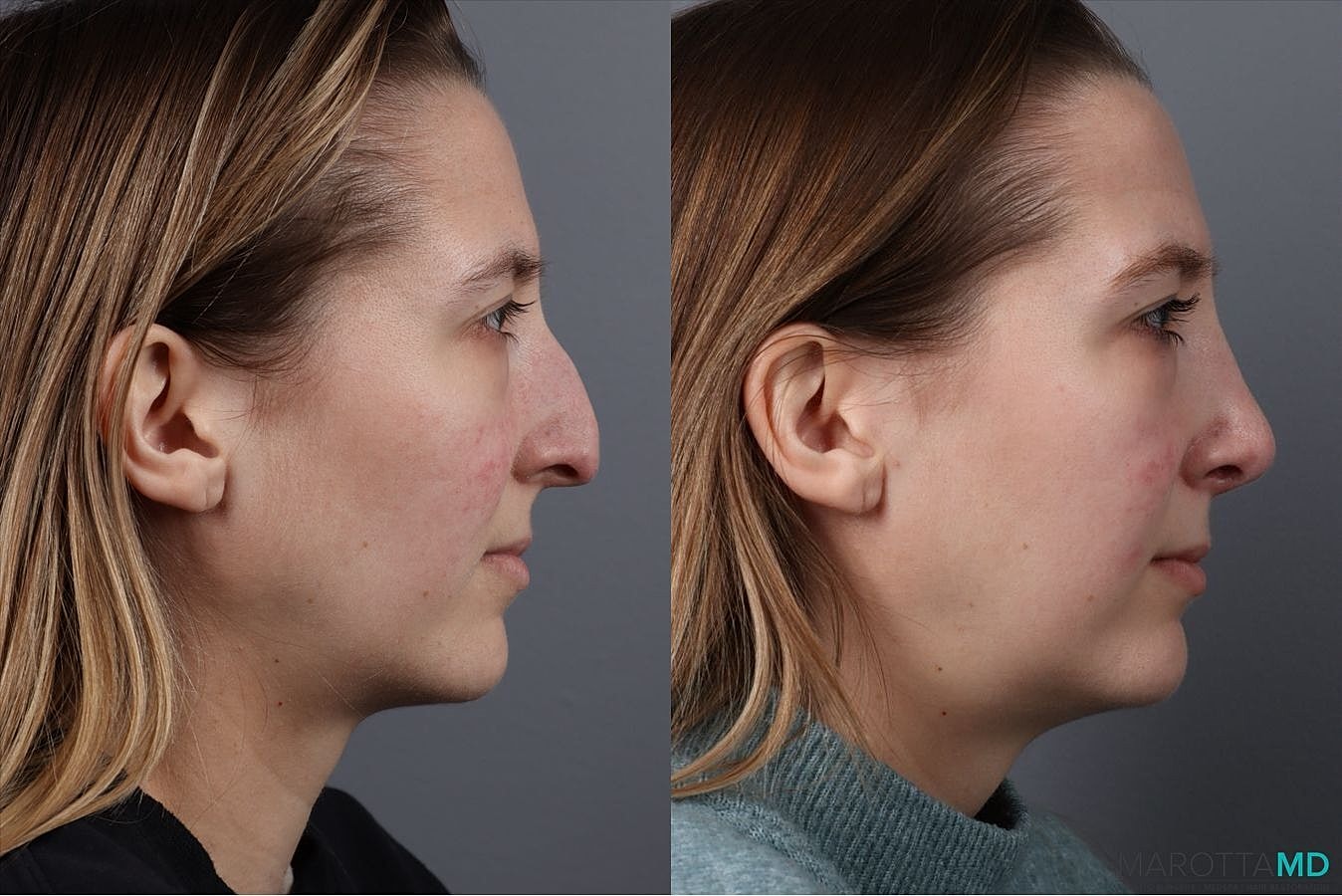 Nose Surgery Before & After