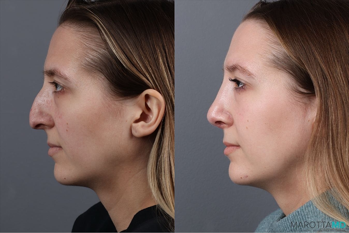 Nose Surgery Before & After