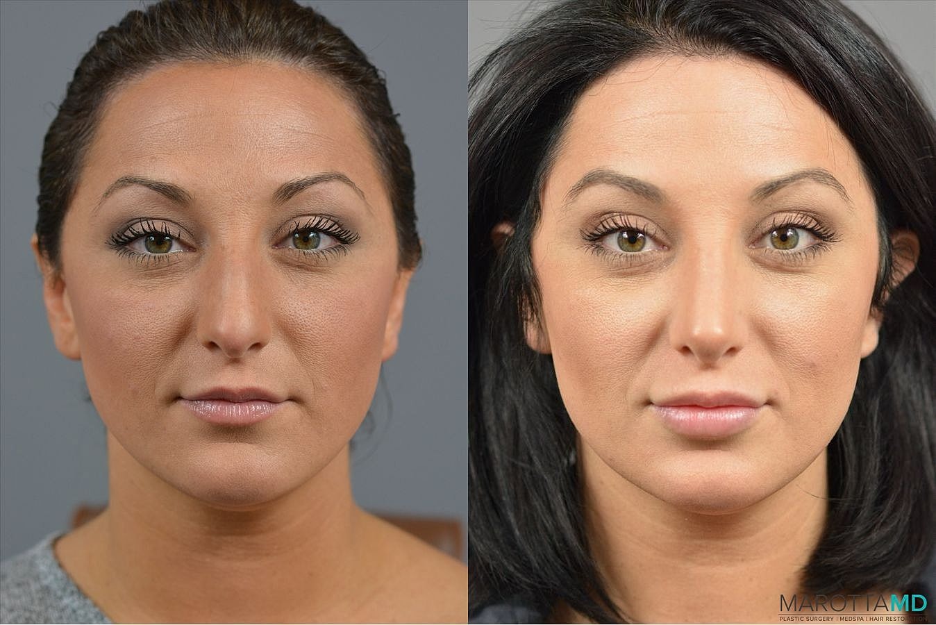 Nose Surgery Before & After