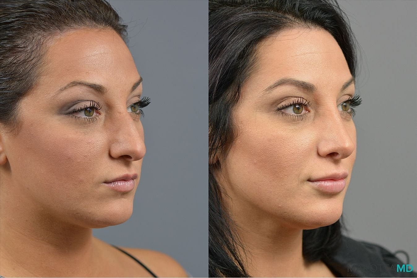 Nose Surgery Before & After