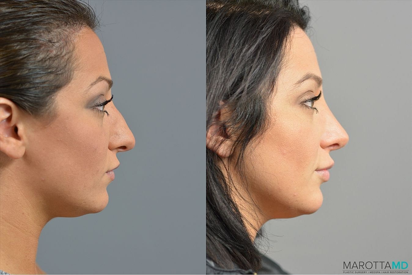 Nose Surgery Before & After