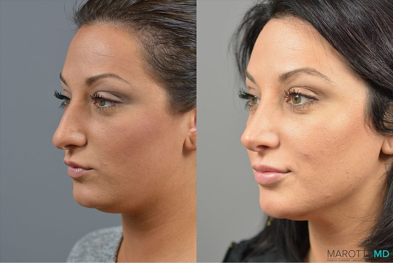 Nose Surgery Before & After