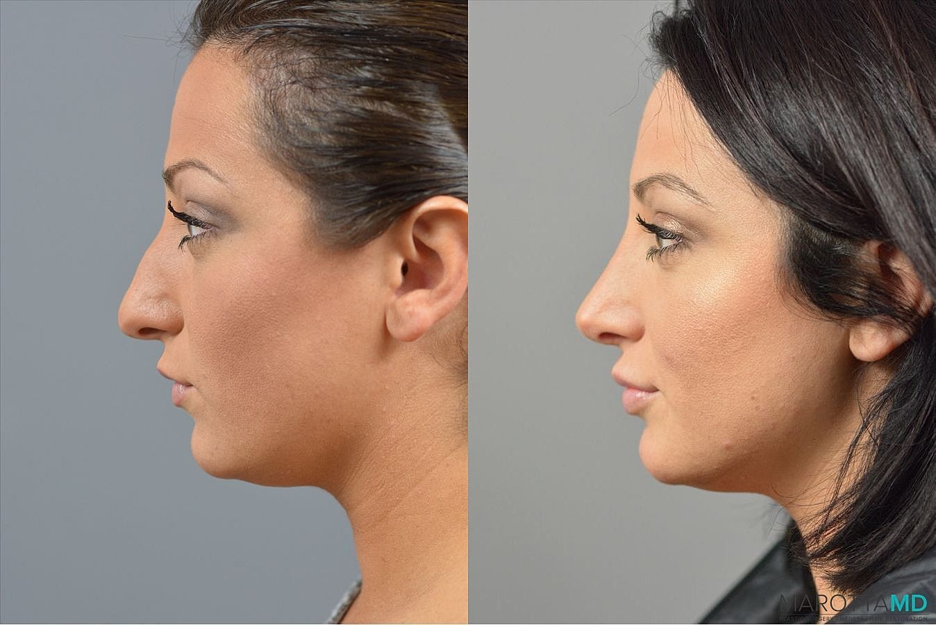 Nose Surgery Before & After