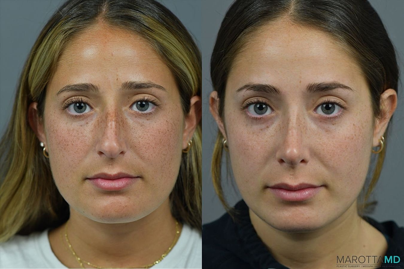 Nose Surgery Before & After