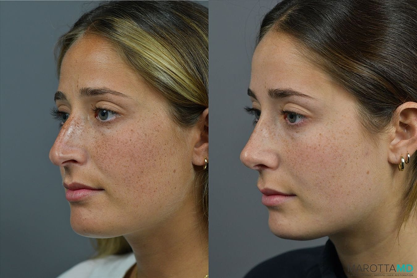 Nose Surgery Before & After