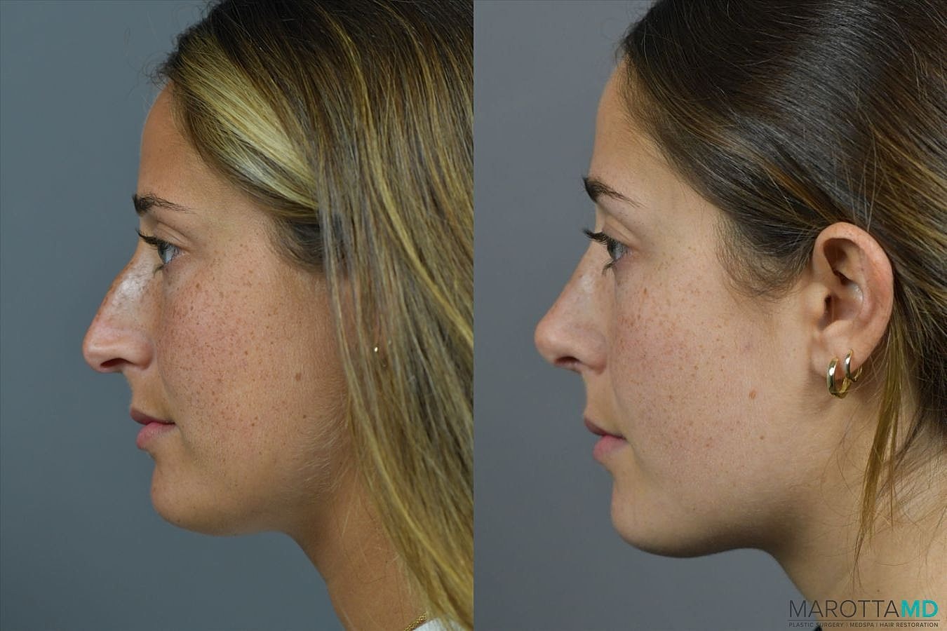Nose Surgery Before & After