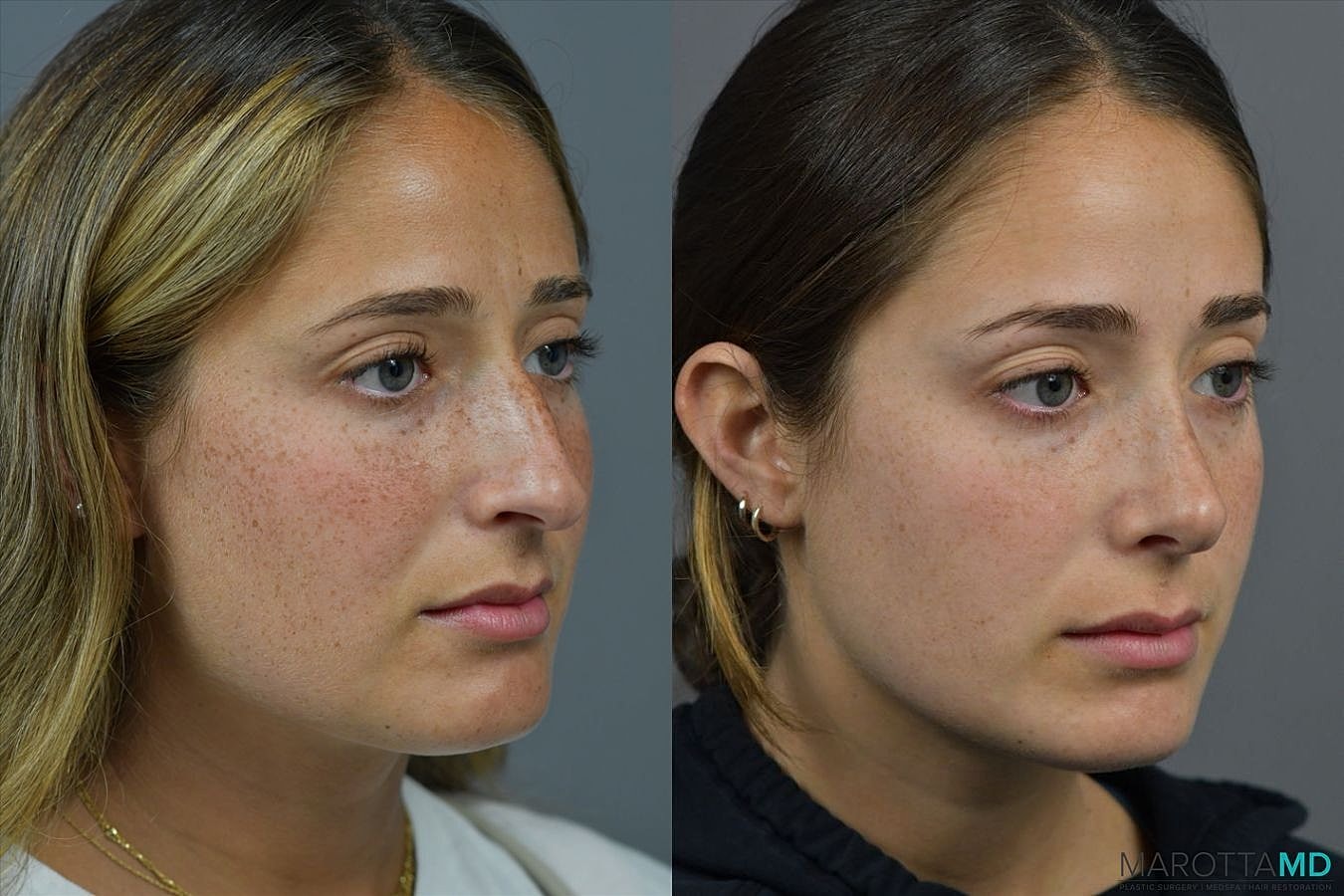 Nose Surgery Before & After