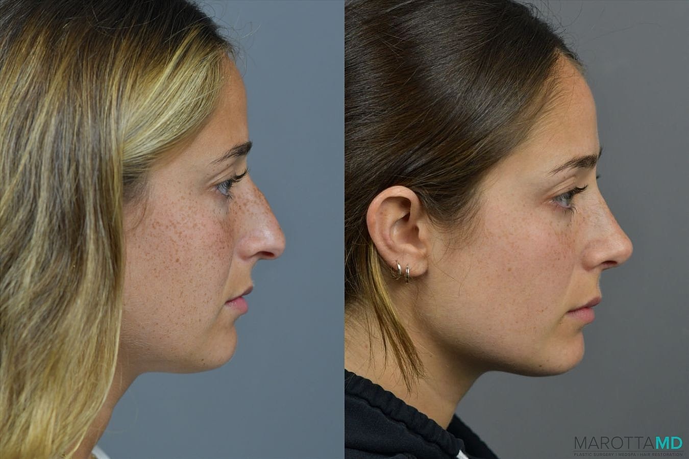 Nose Surgery Before & After