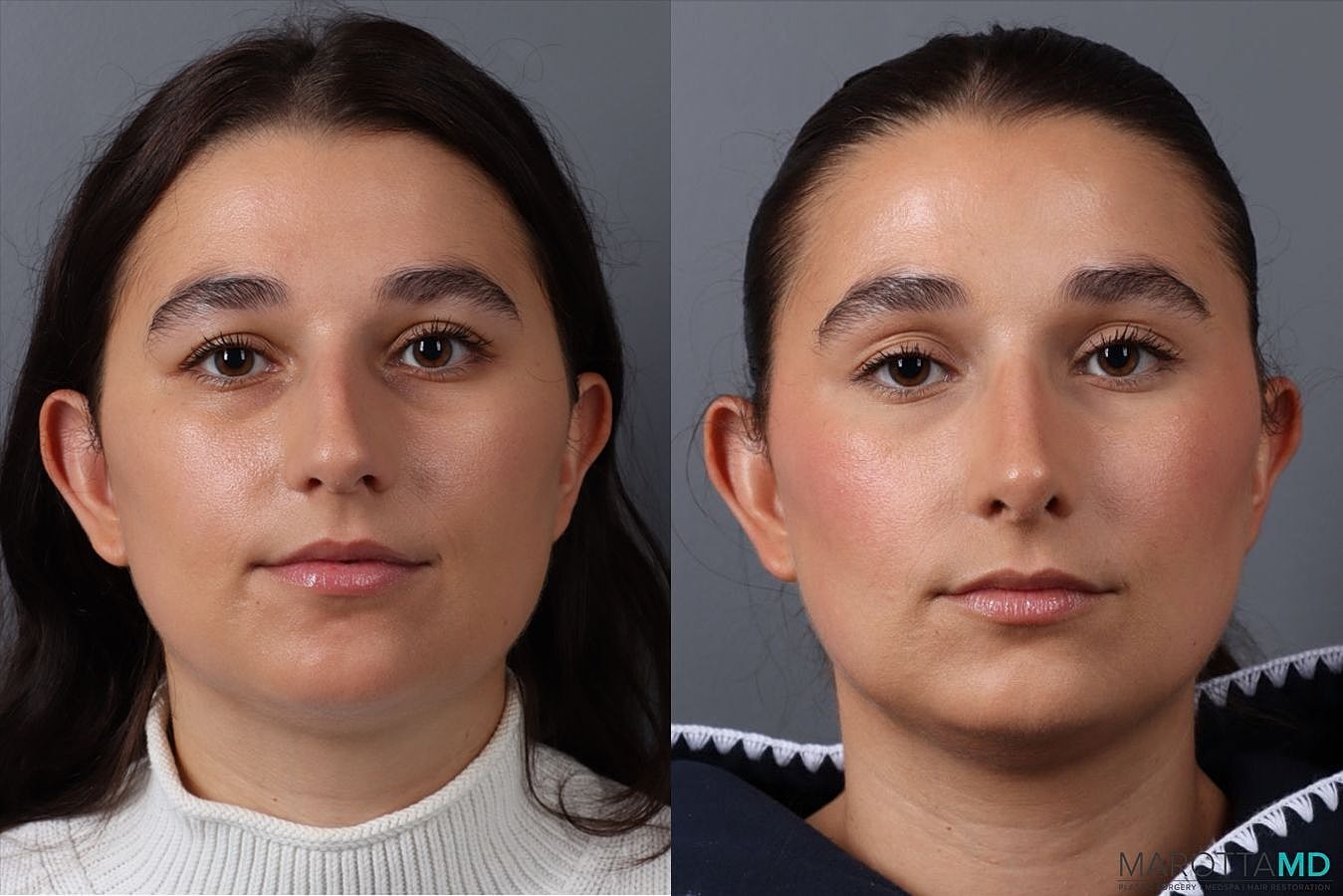 Nose Surgery Before & After