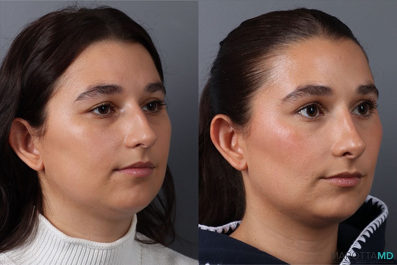 Nose Surgery Before & After