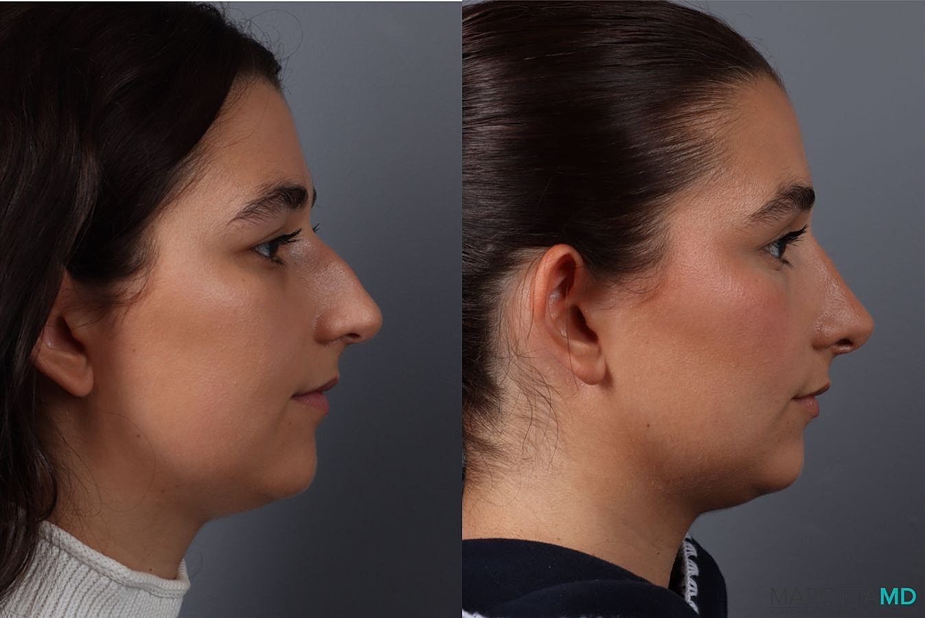 Nose Surgery Before & After