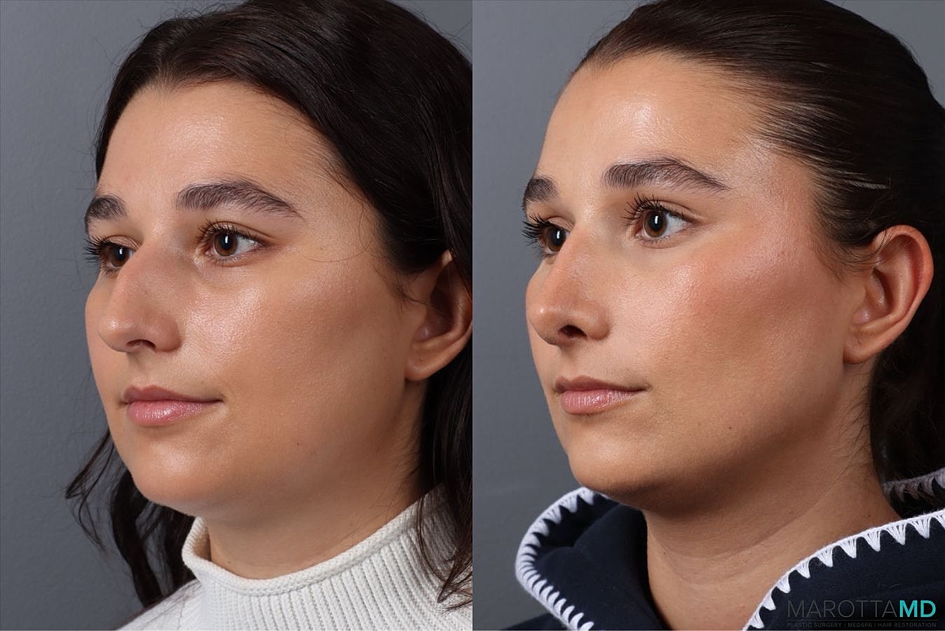 Nose Surgery Before & After