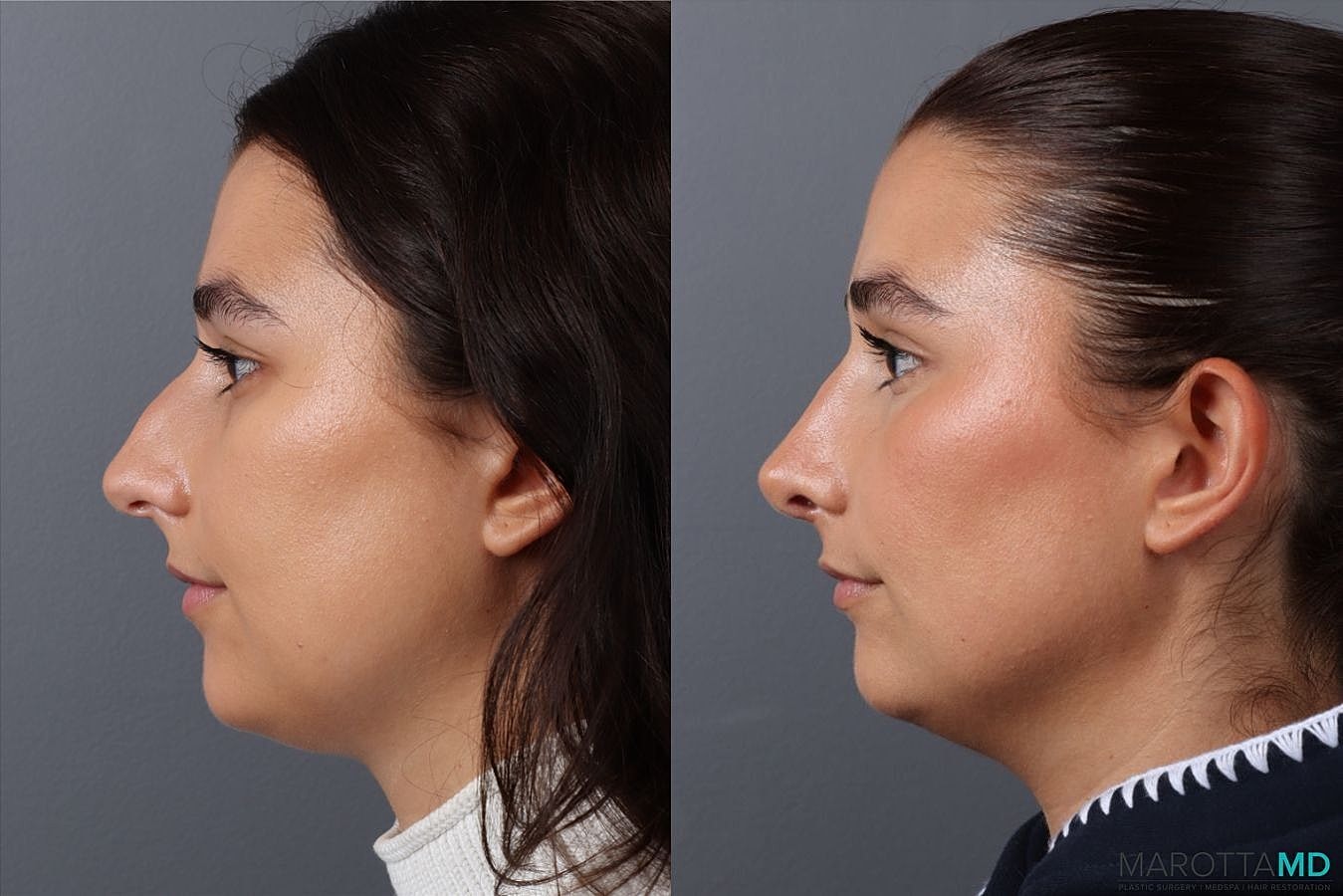 Nose Surgery Before & After