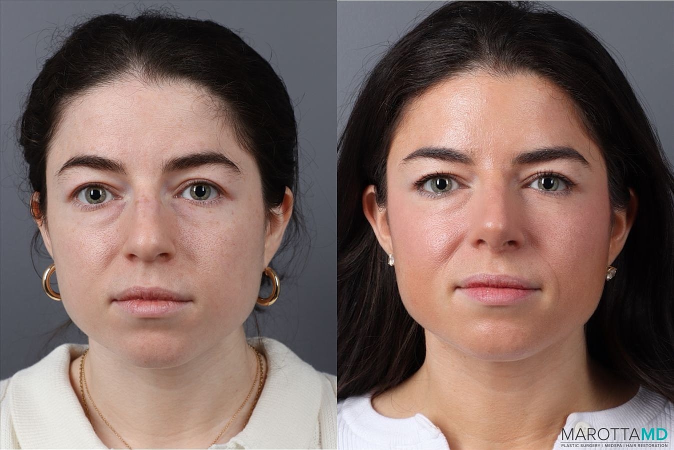 Nose Surgery Before & After