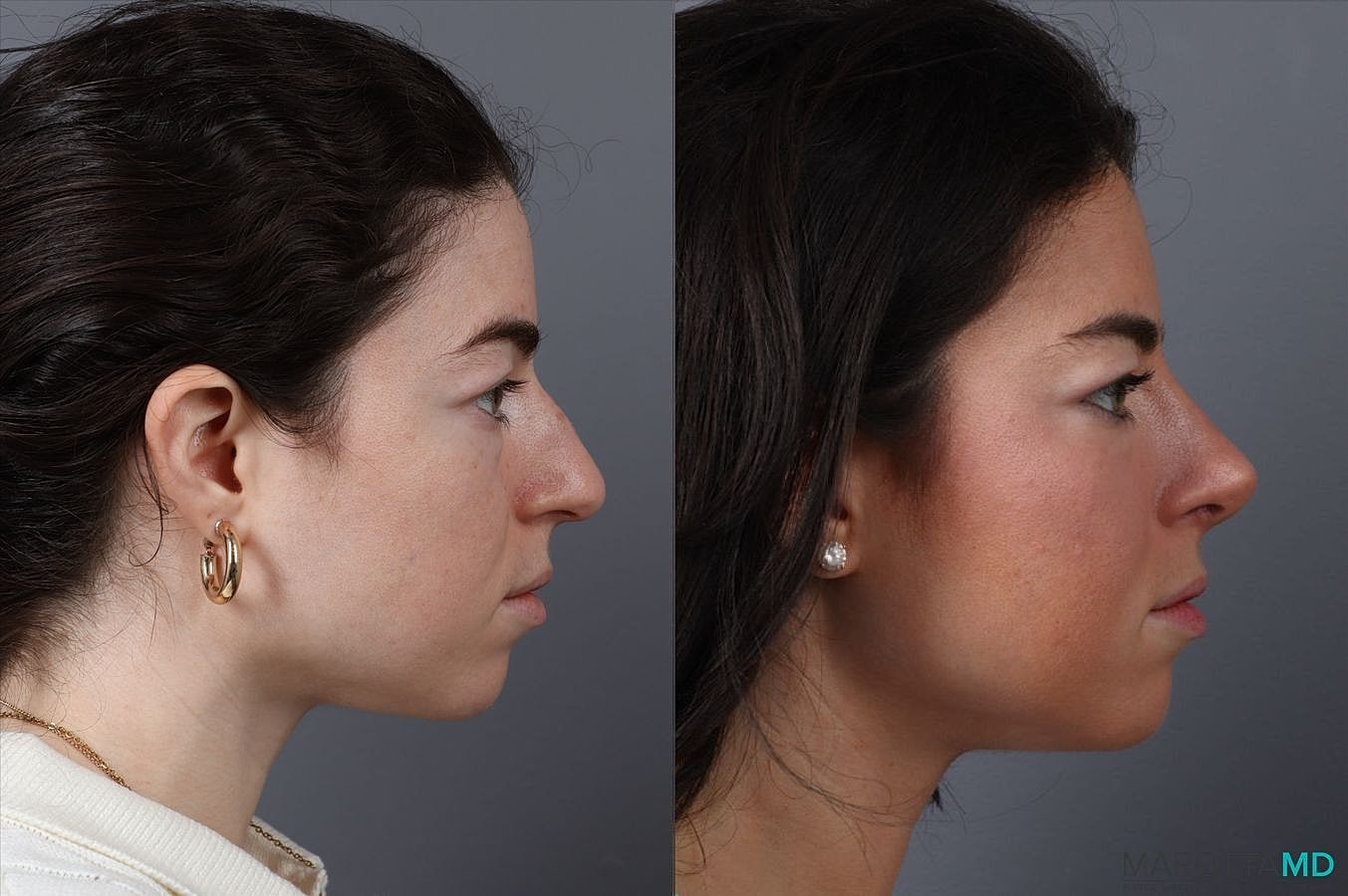 Nose Surgery Before & After