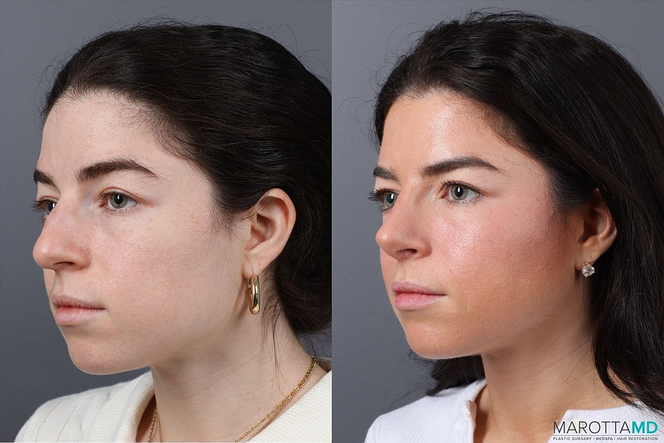 Nose Surgery Before & After