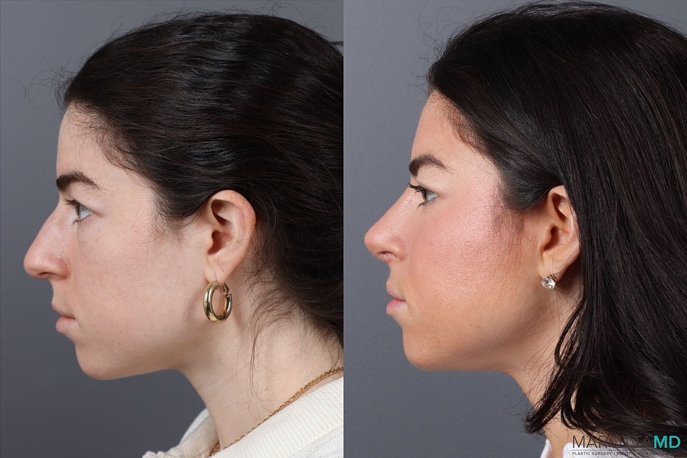 Nose Surgery Before & After