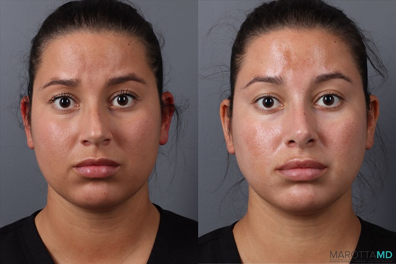 Nose Surgery Before & After