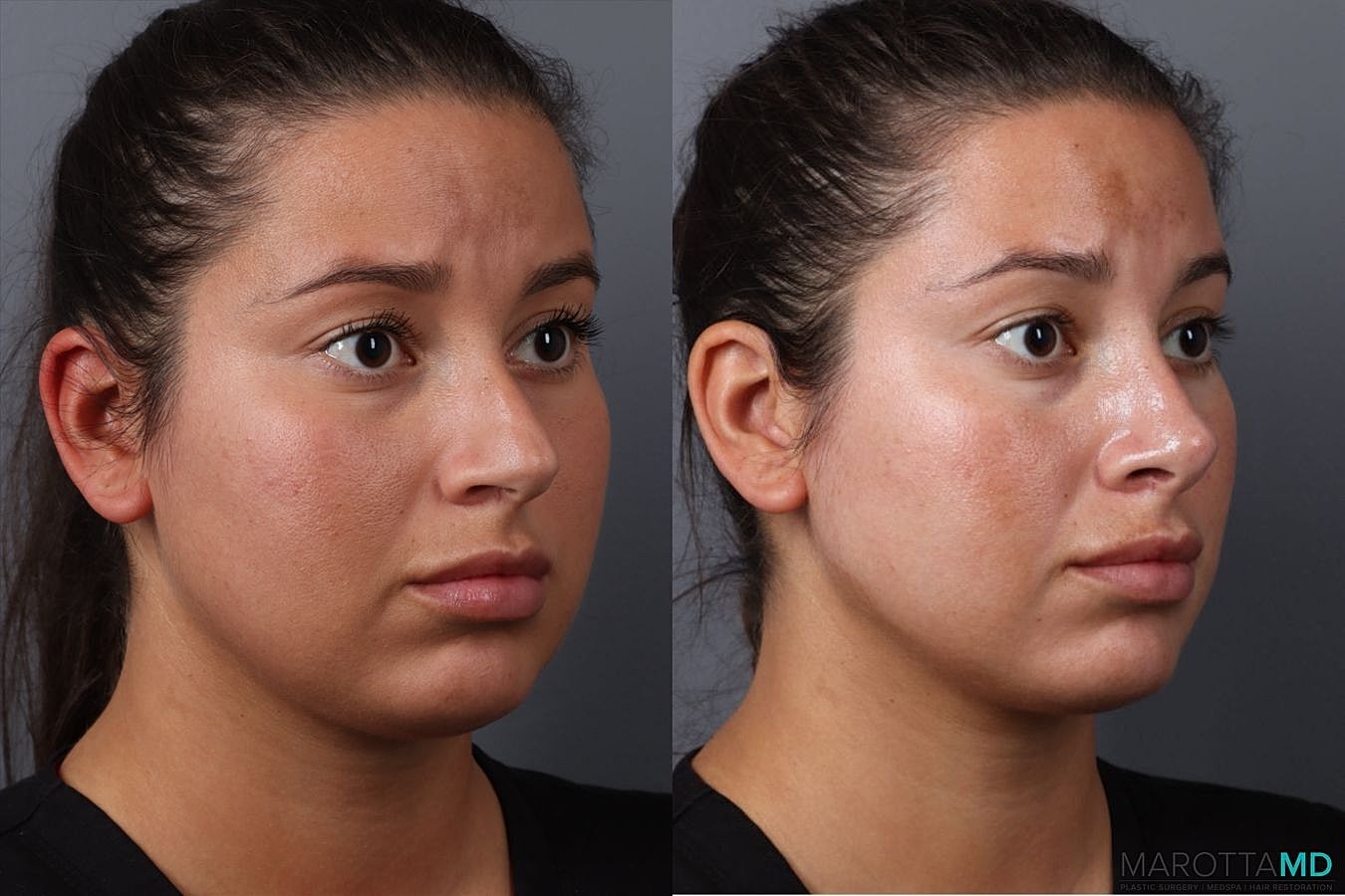 Nose Surgery Before & After