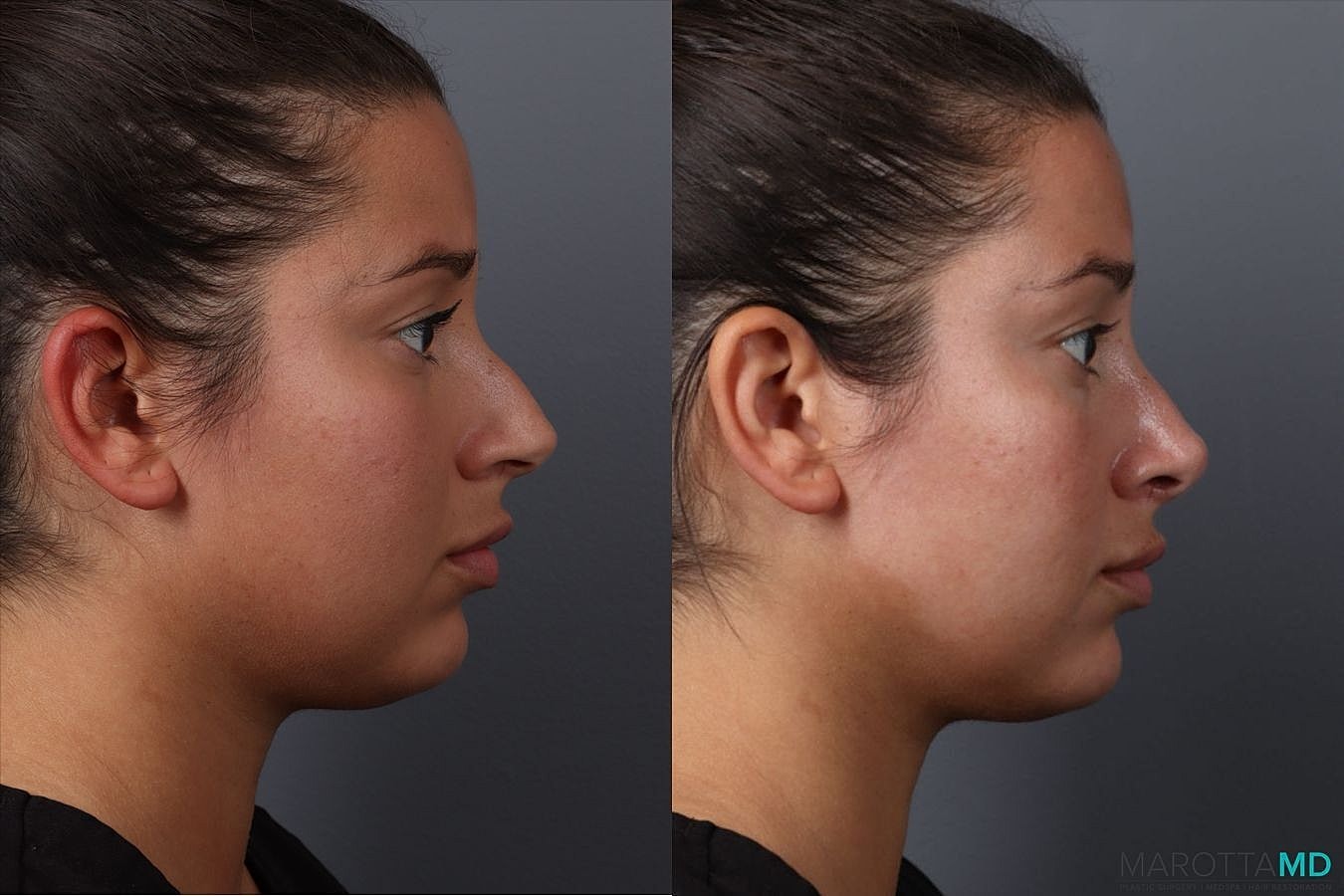 Nose Surgery Before & After